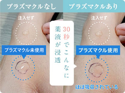 痛いのは本当？】プラズマクル美顔器の口コミや効果、使い方を徹底解析