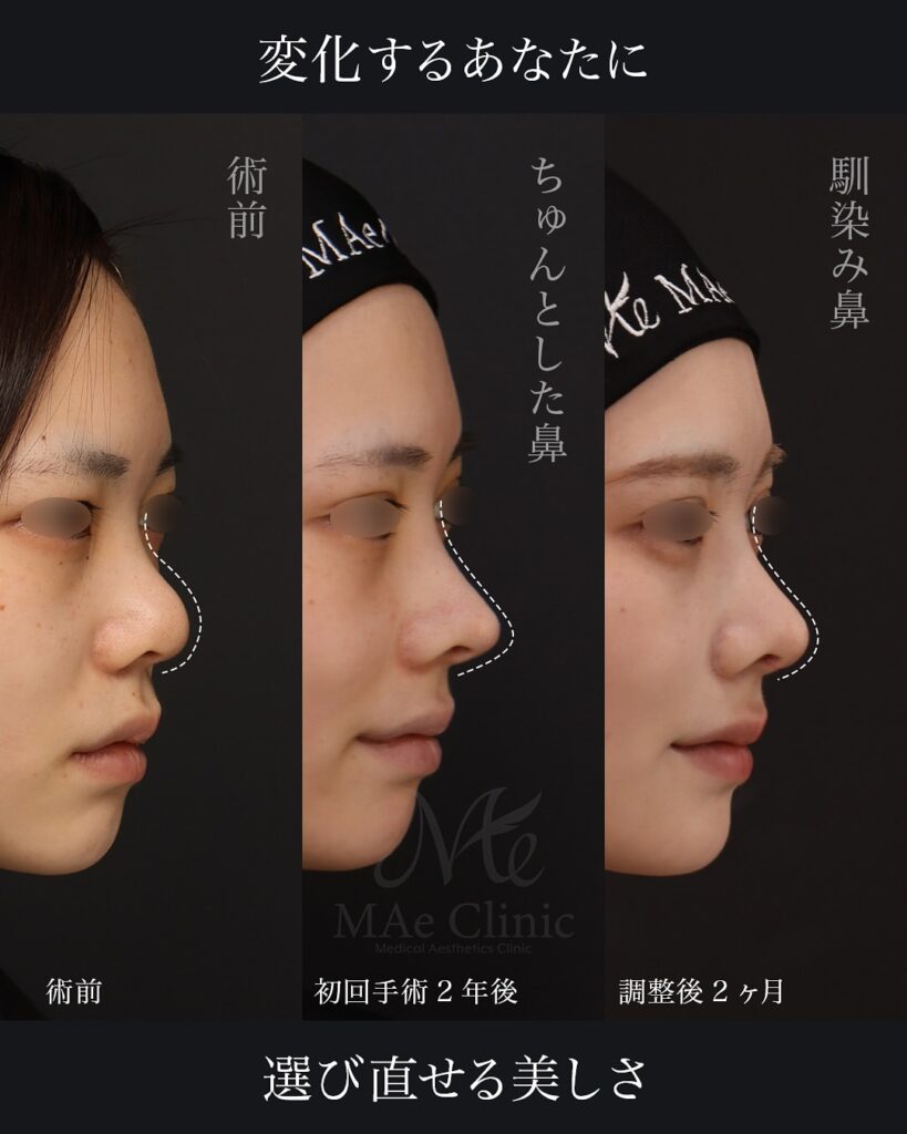 2年前の鼻整形を、今の自分に合わせて再デザイン｜前田翔医師による