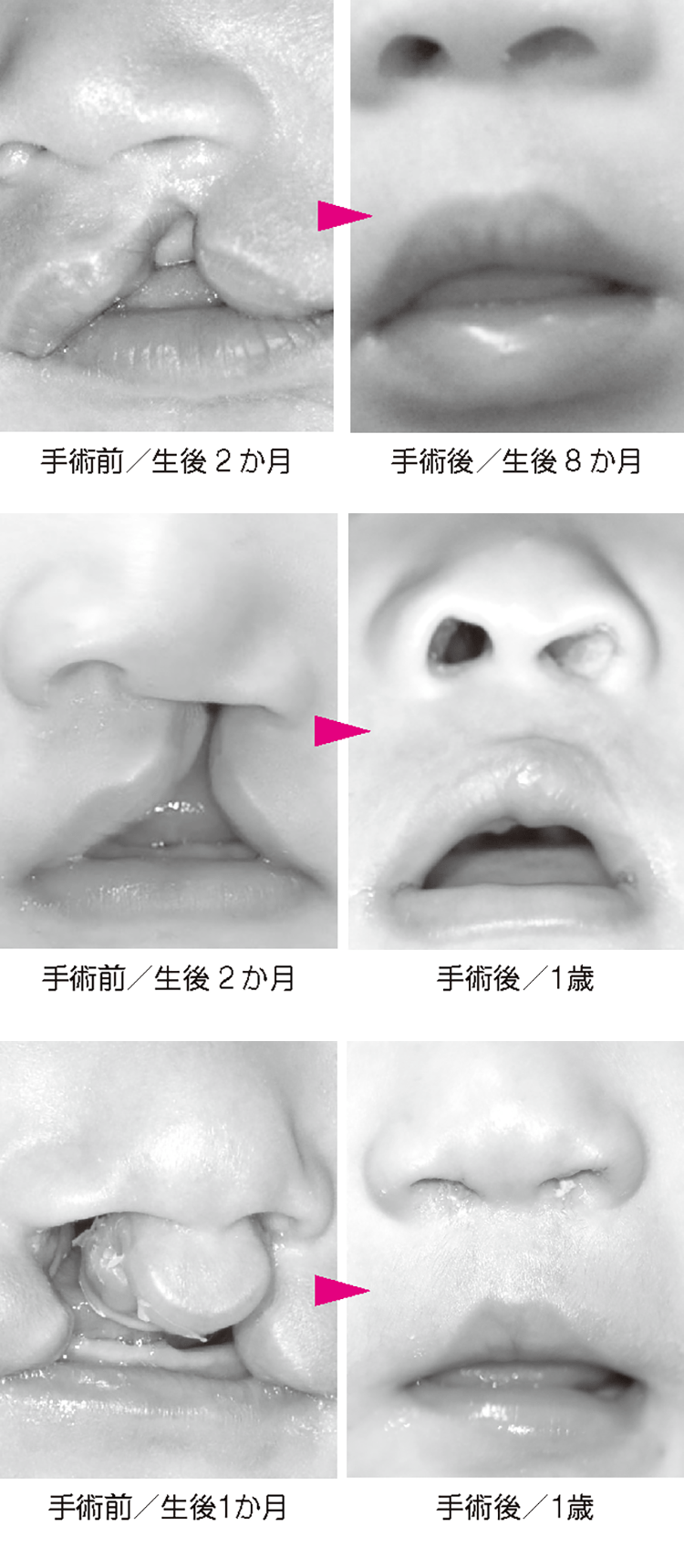 口唇裂・口蓋裂のお話 | 病気と治療の検索サイト「メディカルブレイン」