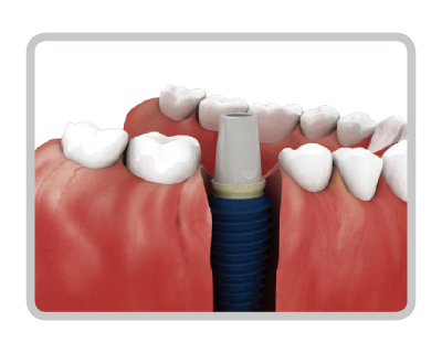 911kit｜製品情報｜株式会社メガジェンジャパン｜歯科用インプラント