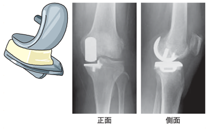 人工ひざ関節置換術の適応時期を解説 | 桃谷うすい整形外科｜大阪