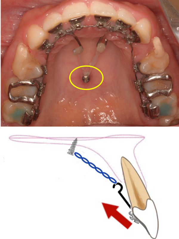 歯科矯正用アンカースクリューを用いた治療｜見えにくい装置で矯正治療