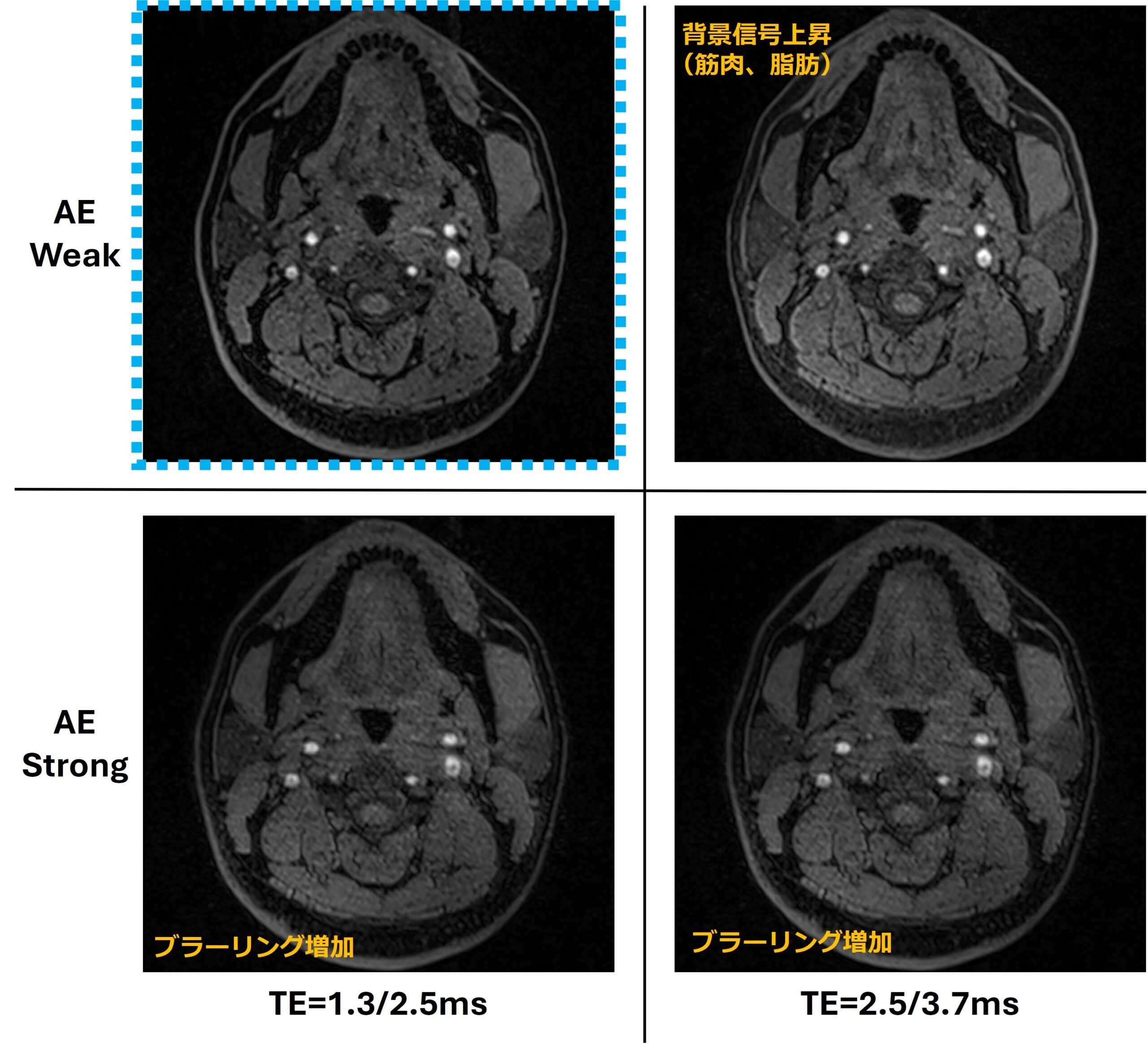 古い装置でもあきらめない！？頭頚部MRA時短撮像 | MRIfan.net