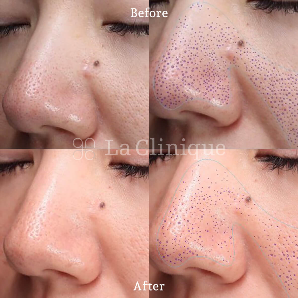 ポテンツァ 大阪・名古屋（ニキビ跡・毛穴・肝斑・肌質改善） | La