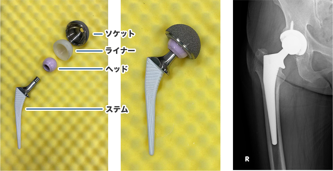 人工股関節置換術（Total Hip Arthroplasty, THA） | おゆみの中央病院