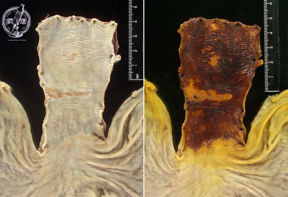 8.食道・胃 (3)食道癌（扁平上皮癌）|病理コア画像