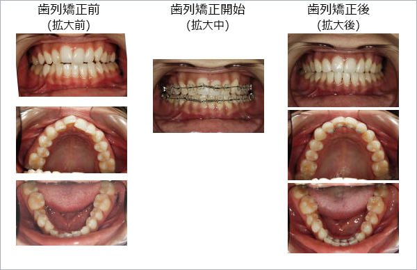 非抜歯矯正治療 | 福岡市博多区博多駅近くの矯正歯科・審美歯科さあ
