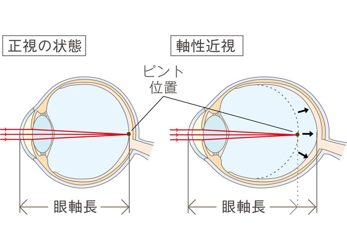 マイオピン点眼について | さとう眼科