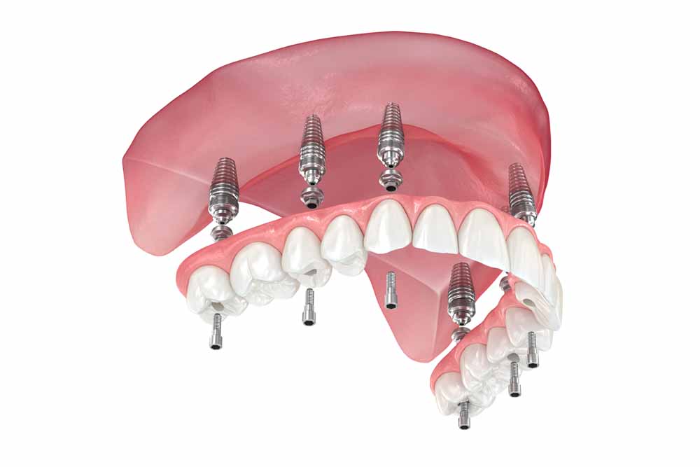 無歯顎補綴治療学 第4版 無歯顎補綴治療学 第