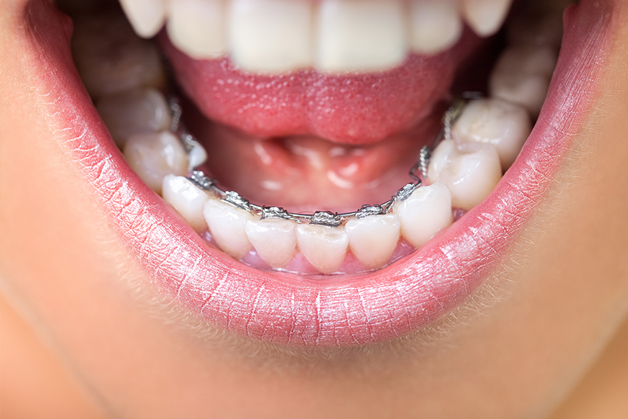 裏側矯正(リンガルブラケット矯正法) - 渋谷駅すぐの矯正歯科 渋谷