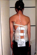 側湾症 【大塚整体治療院】 そくわん症 側わん症 側弯症