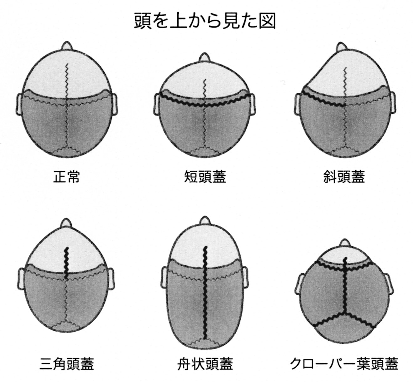 Neuroinfo Japan：頭蓋骨縫合早期癒合