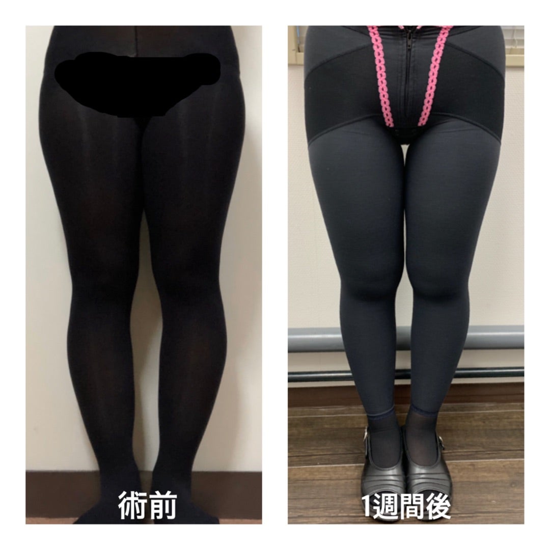 スタッフ脂肪吸引【7日目】 | 湘南美容クリニック川崎院スタッフのブログ