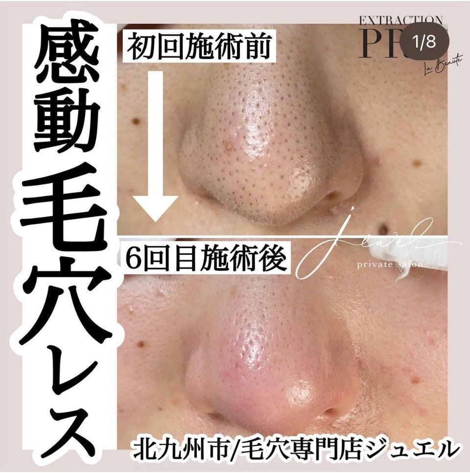 毛穴エクストラクションプロとは？ | 育児中でも自宅で学べる毛穴