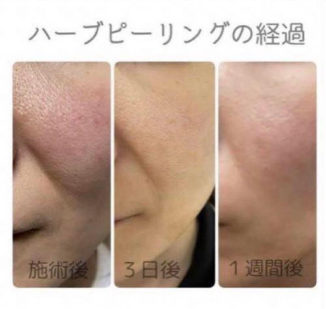 ハーブピーリング剥離なし 10回分(10g)業務用 - メルカリ