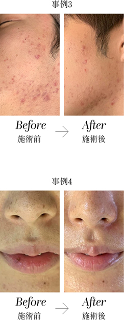 Needle peeling®｜株式会社アイセル｜ニードルピーリング・育肌ハーブ