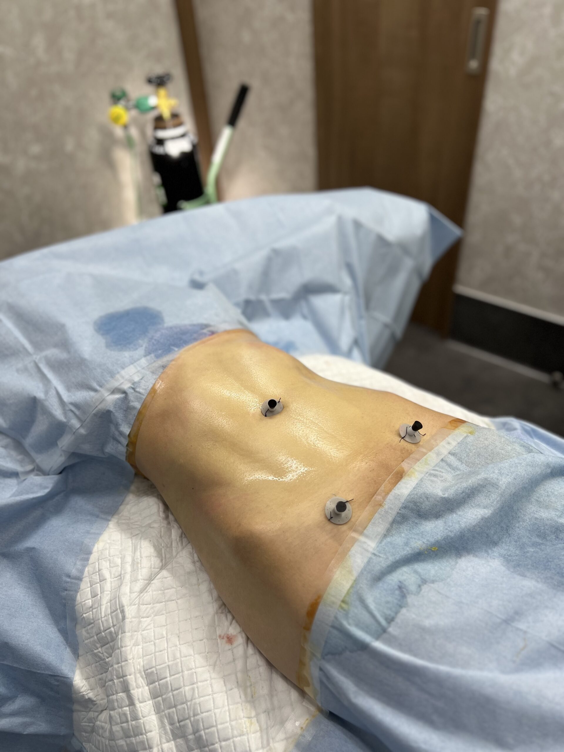 裁断済み】安全で失敗しない脂肪吸引の手術 裁断済み】安全で失敗