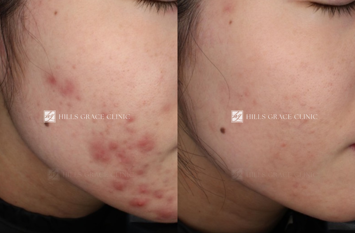 繰り返すニキビに｜デュアリティーフェイスクリーム | グレイスジャーナル