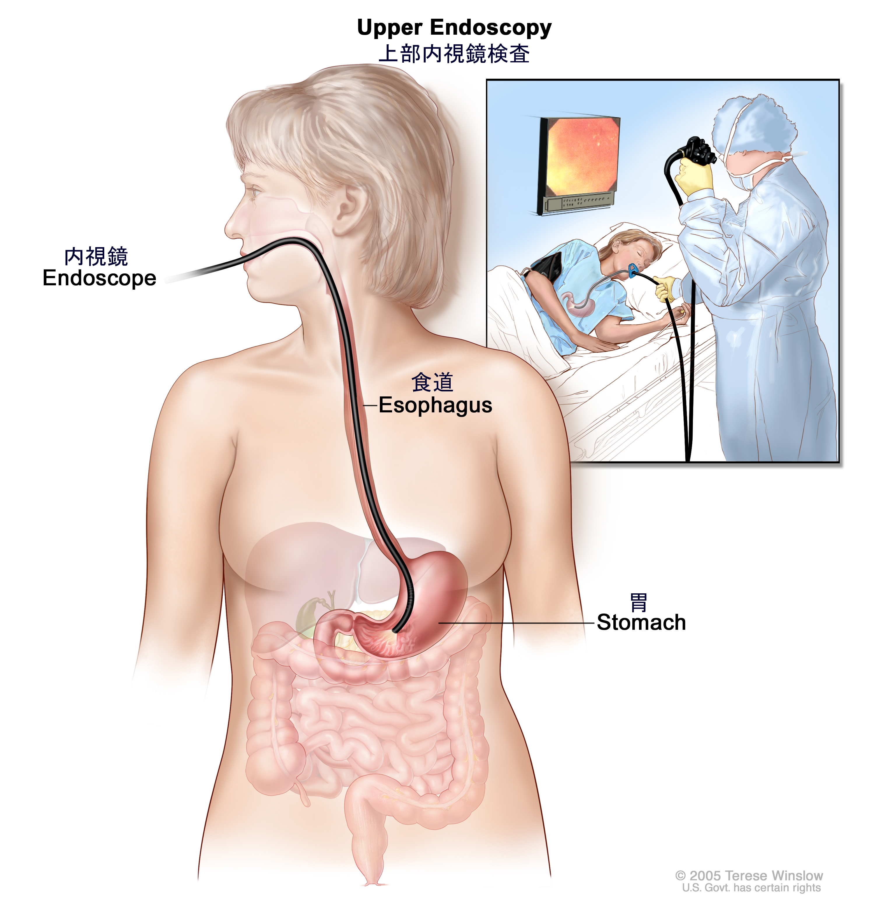 がん情報サイト | がん情報各論：[患者さん向け]胃がんの