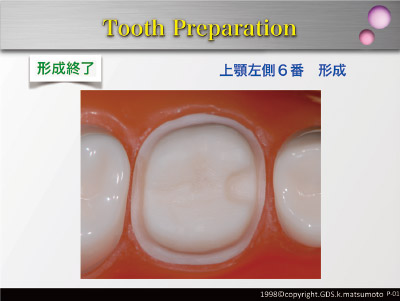 モリタ】コンセプト優先型支台歯形成用 バーセット「SELF CREATOR