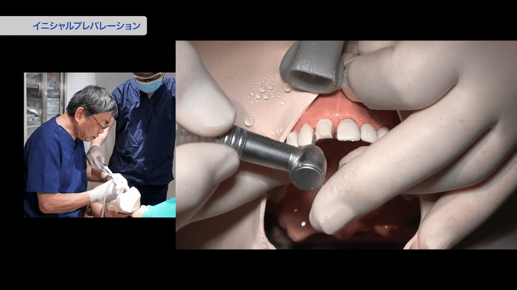 速く・上手に！誰でもできる支台歯形成テクニック | 株式会社 医療情報