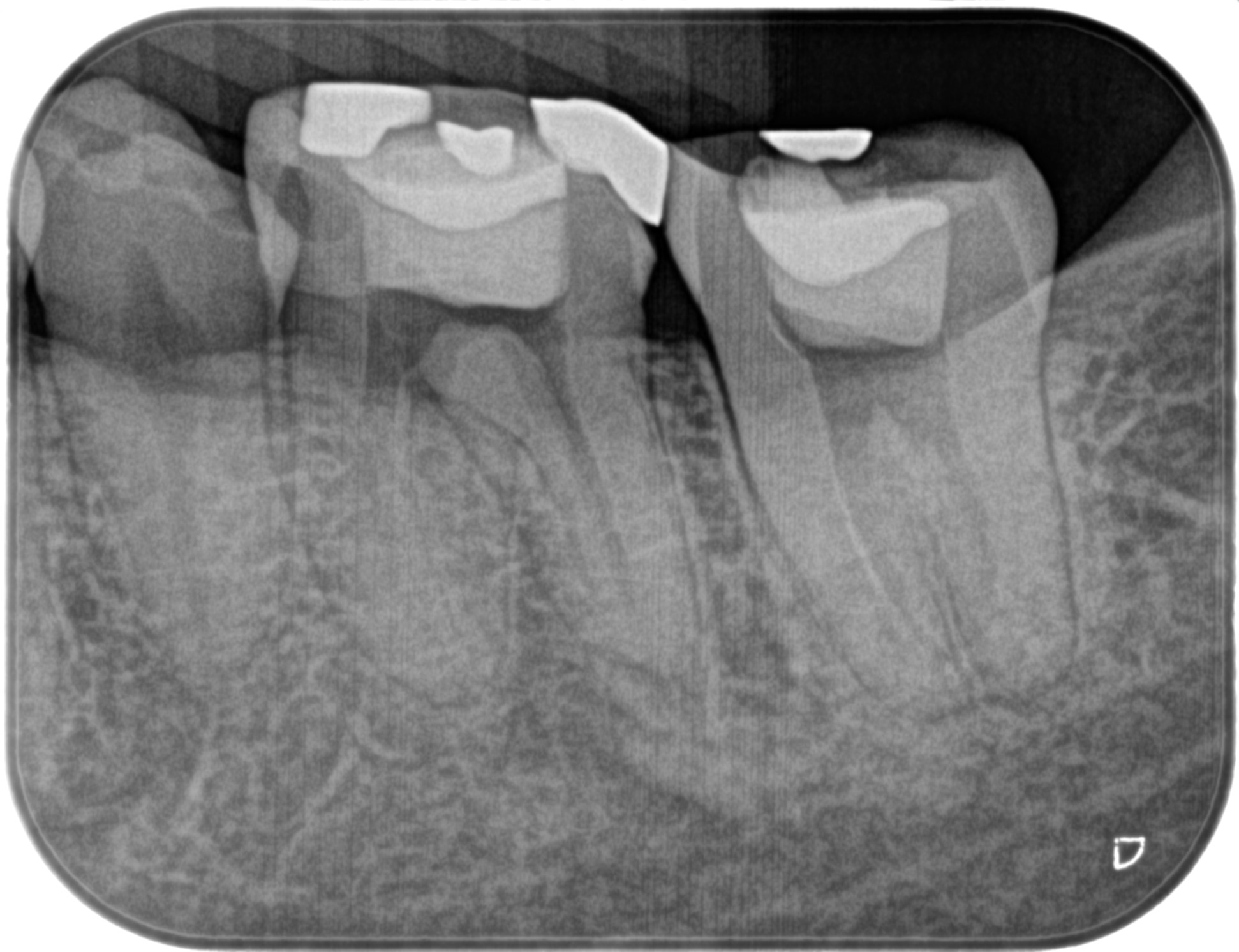 Previously Initiated Therapyの歯内療法は事実上、再根管治療…その